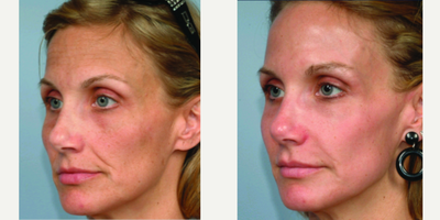 Dermal Fillers before and after photo