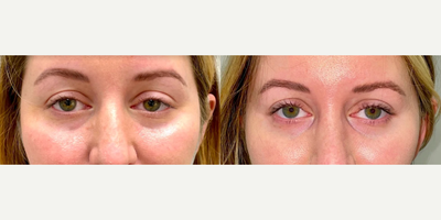 Dermal Fillers before and after photo