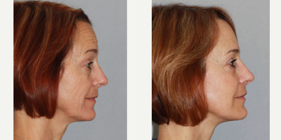 Facelift before and after photo