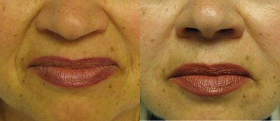 Juvederm before and after photo