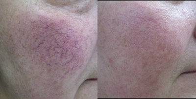 Pulsed Dye Laser before and after photo