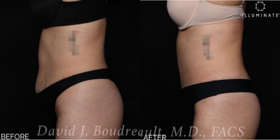 Tummy Tuck before and after photo