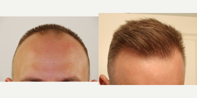 ARTAS Robotic Hair Transplant before and after photo