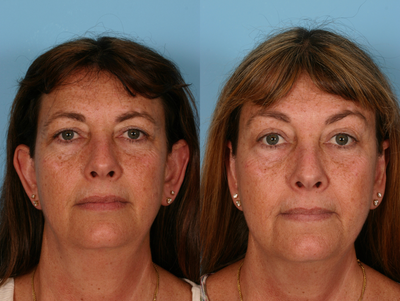 Brow Lift before and after photo