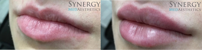 Juvederm before and after photo