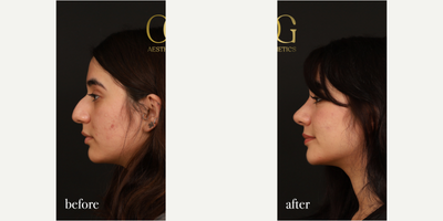 Rhinoplasty before and after photo