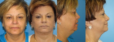 Facelift before and after photo