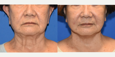 Facelift before and after photo
