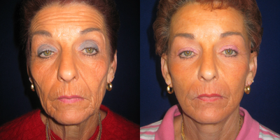 Facelift before and after photo