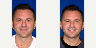 Smile Makeover before and after photo