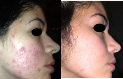 Accutane before and after photo