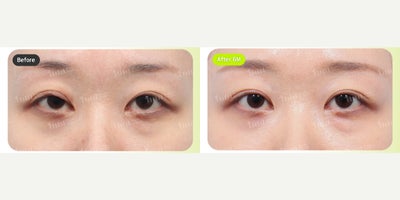 Canthoplasty before and after photo