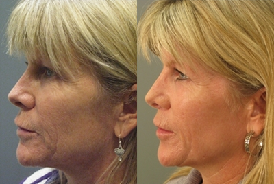 Fractional Laser before and after photo