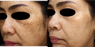 PicoSure before and after photo