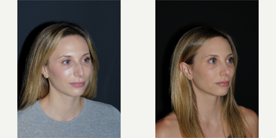 Rhinoplasty before and after photo