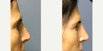 Rhinoplasty before and after photo