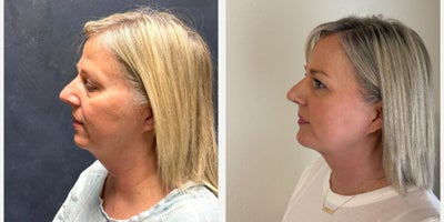 Chin Liposuction before and after photo