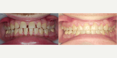 Clear Braces before and after photo
