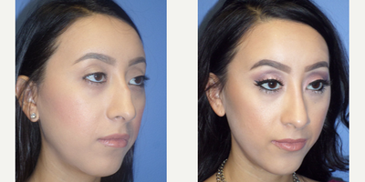 Rhinoplasty before and after photo
