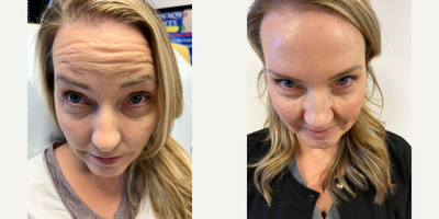 Botox before and after photo