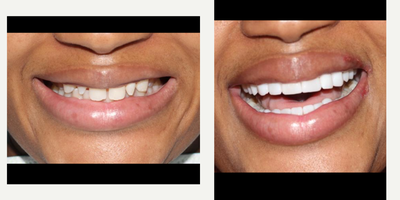 Da Vinci Veneers before and after photo