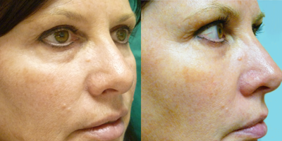 Dermal Fillers before and after photo