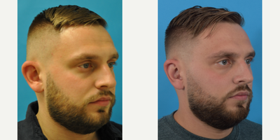 Ear Surgery before and after photo