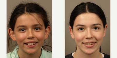 Ear Surgery before and after photo