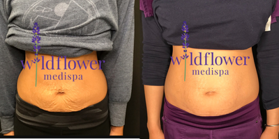 Exilis before and after photo