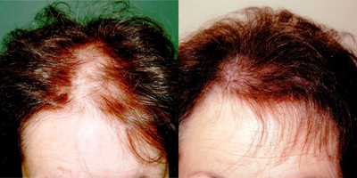 Hair Transplant before and after photo