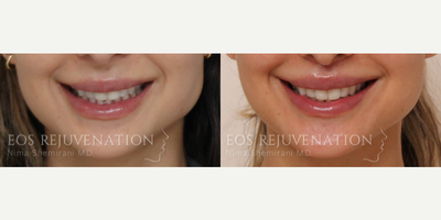 Lip Lift before and after photo