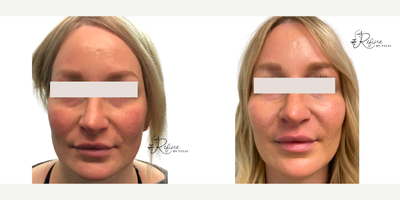 Cheek Fillers before and after photo