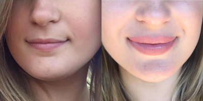 Dermal Fillers before and after photo