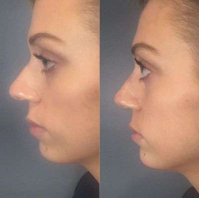 Dermal Fillers before and after photo