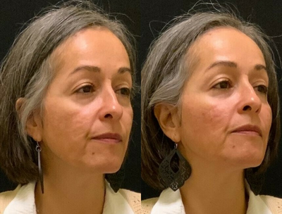 Dermal Fillers before and after photo