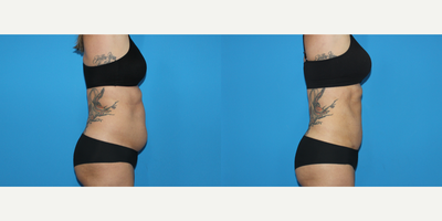 Liposuction before and after photo