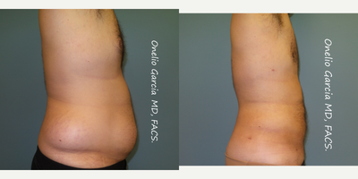 Vaser Liposuction before and after photo