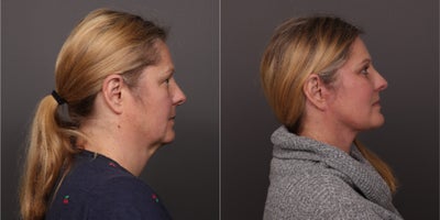 Facial Fat Transfer before and after photo