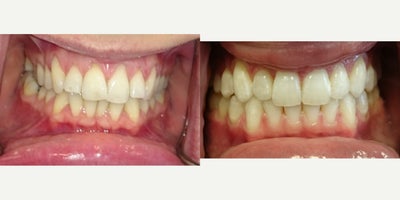 Invisalign before and after photo