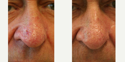 Laser Resurfacing before and after photo