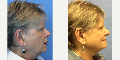 Neck Lift before and after photo