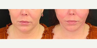 Nonsurgical Facelift before and after photo