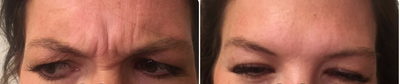Botox before and after photo