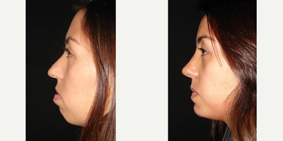 Chin Implant before and after photo