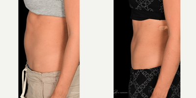 Emsculpt before and after photo