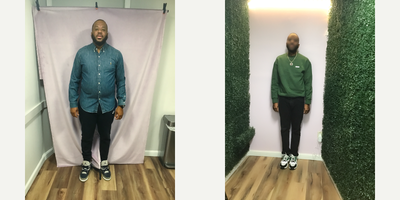Endoscopic Sleeve Gastroplasty before and after photo