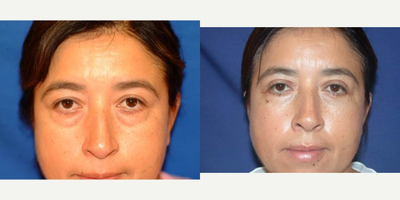 Eyelid Surgery before and after photo