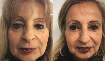 Facial before and after photo