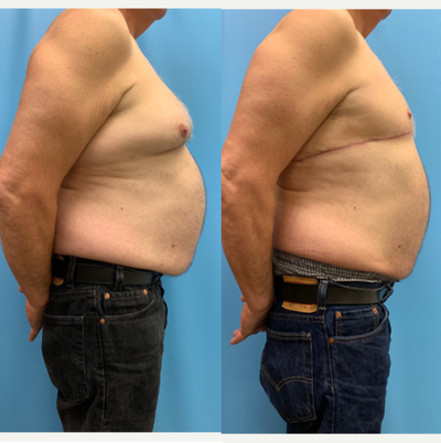 Gynecomastia Surgery before and after photo