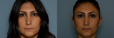 Revision Rhinoplasty before and after photo
